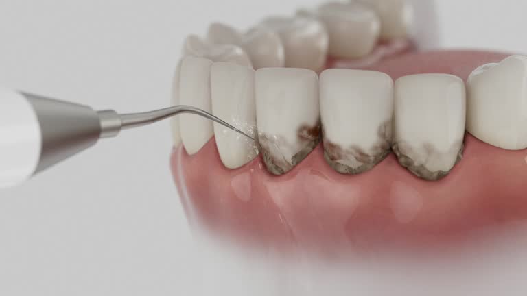 Reliable Dental Implants contractor in Lakeport, TX by Smile Center Dentistry